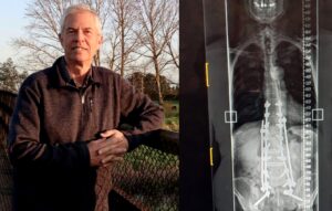 Read more about the article Former mayor back on feet after spinal surgery